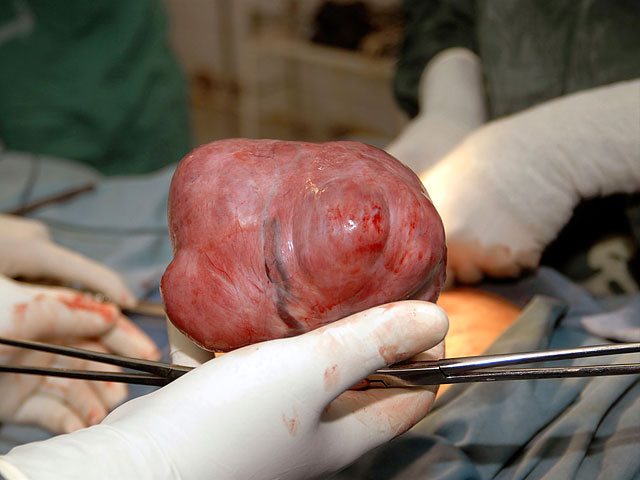 Удаление опухоли матки хирургическим путем