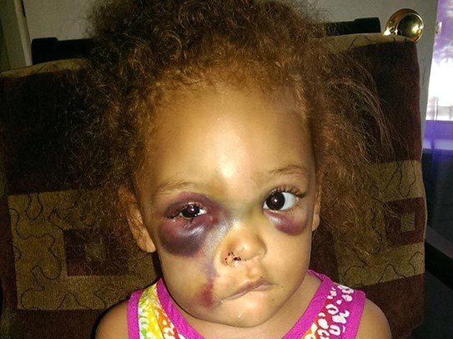 Американка опубликовала ФОТО обезображенного лица 5-летней дочери, чтобы доказать факт ее избиения в школе