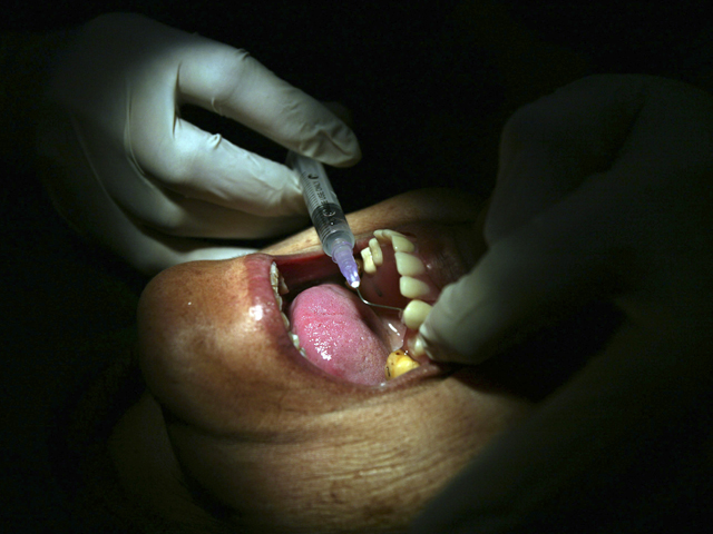 В Индии успешно завершилась довольно редкая и сложная хирургическая операция - у семилетнего мальчика по имени Вивек удалили 80 зубов