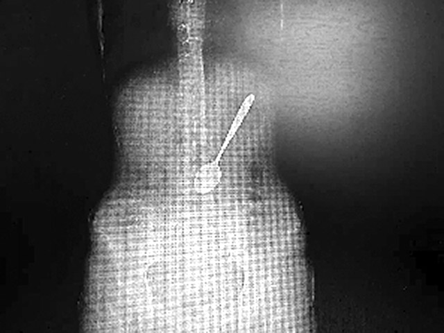 Врачи города Янчжоу в провинции Цзянсу извлекли 15-сантиметровую ложку из желудка 27-летней пациентки, которая проглотила столовый прибор, увлекшись поеданием лапши