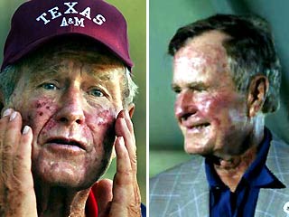 Журналисты были ошеломлены, когда увидели Буша-старшего: всего его лицо было изуродовано большими красными язвами