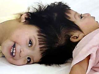 Девочки-близнецы, сросшиеся головы которых были разделены в ходе уникальной операции в Лос-Анджелесе, чувствуют себя хорошо