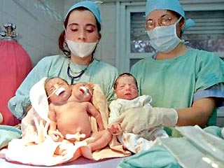 В Аргентине родидились уникальные сиамские близнецы
