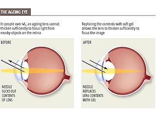 Избавиться от проблем со зрением поможет гелевый хрусталик глаза