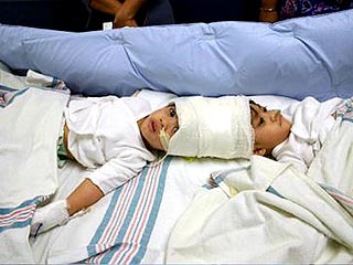 Первая из серии операций по разделению сросшихся головами полуторогодовалых сиамских близнецов из Филиппин проведена в понедельник в Нью-Йорке