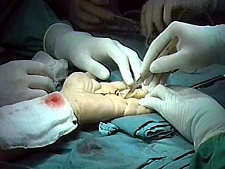  В Испании хирурги пришили пациенту оторванную руку к ноге, а потом вернули ее на место