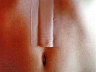 Пластырь наклеивают на живот и носят две недели. Это уже попробовали сделать 562 женщин, перенесших операцию по удалению матки. В ходе эксперимента выяснилось, что 74% из них после применения пластыря получают больше удовольствия от занятия любовью.