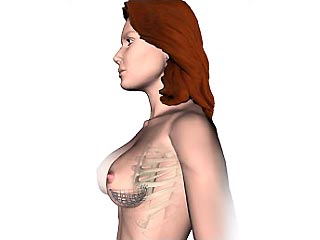 Аргентинский врач предлагает женщинам титановые имплантанты в грудь