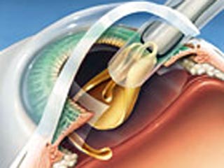 В США разрабатывают имплантанты, которые смогут восстанавливать зрение