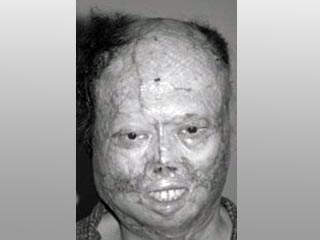 54-летний мужчина был прооперирован врачами токийского медицинского центра Hiroo. Загоревшийся бензин сжег кожу его лица, шеи, груди и рук. У него не осталось носа, и очень сильно пострадали уши