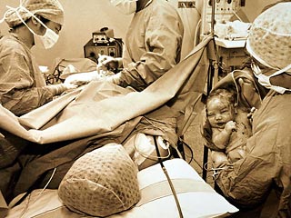 Румынка, которая почти два месяца назад родила первого младенца-близнеца, 7 февраля подарила жизнь его брату. Женщине пришлось сделать кесарево сечение