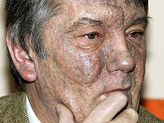 Отравленный диоксином президент Украины Виктор Ющенко живет в страхе перед развитием ракового заболевания