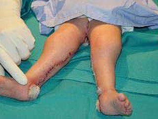 Девятнадцатимесячная перуанка Милагрос Керрон, которая полгода назад перенесла операцию по поводу "синдрома русалки", впервые после снятия бинтов предстала перед публикой