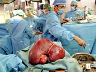 Люди с пересаженными органами стали жить дольше