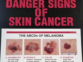 Ученые предупреждают, в США распространяется скрытая эпидемия: рак кожи у каждого пятого
