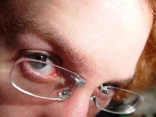 Американский дизайнер Джеймс Соой придумал альтернативу контактным линзам и очкам. Очки-пенсне крепятся не на переносицу, а непосредственно в переносицу