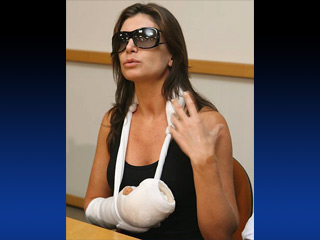В Бразилии 35-летняя бывшая "Мисс Бразилия" Лейла Шустер пострадала от нападения уличных грабителей. Врачи провели женщине хирургическую операцию по восстановлению фаланг трех пальцев