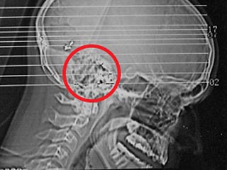 Житель Екатеринбурга выжил после того, как пуля дважды прошла через его мозг и застряла в черепе