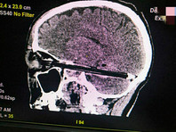 Мужчина поступил в горбольницу Ростова-на-Дону с шариковой ручкой, прошедшей через его глаз и мозг. По данным врачей, ручка вошла в мозг на всю глубину черепа - в миллиметре от важнейших сосудов и ствола головного мозга